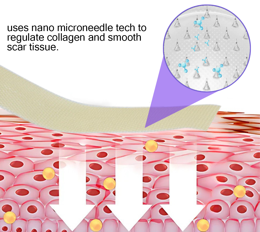 Official Store: ReGen Microneedles Pro Patches with Hyaluronic Acid Nano-Heal Treatment for new and old scars, reduction of surgical scars, stretch marks, keloids, acne, burns, warts, dermatomas, and varicose veins